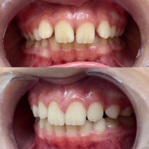 Ортодонтические лечения (на брекет системах и пластинках)